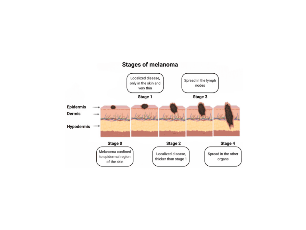 Diagram of melanoma stages showing skin cancer progression from Stage 0 (confined to the epidermis) to Stage 4 (spread to other organs), highlighting key characteristics of each stage.