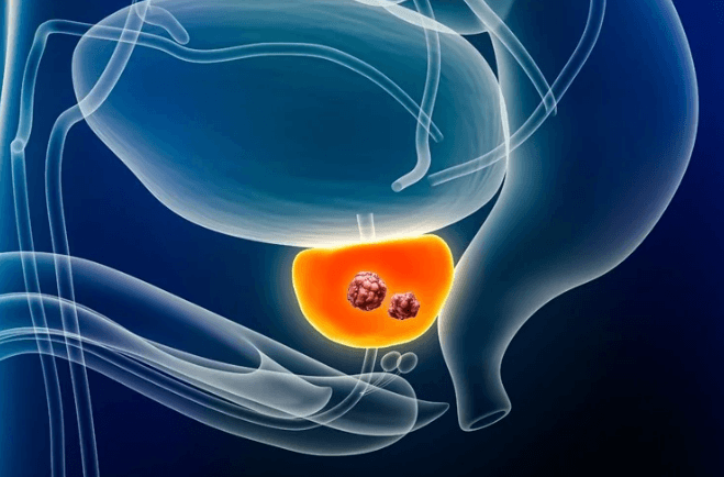 3D medical illustration showing advanced prostate cancer spreading from the prostate to nearby tissue.