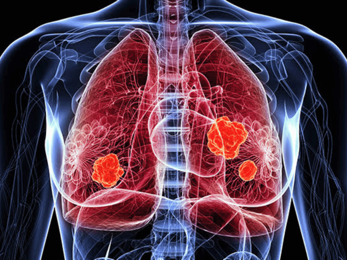 Medical illustration of a chest scan showing tumors in the lungs, highlighting the importance of early lung cancer detection.