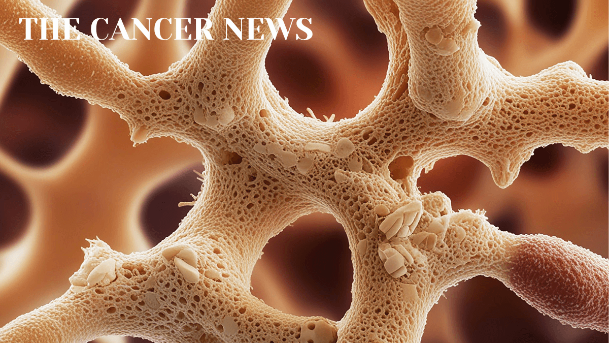 Advanced Chondrosarcoma Finally Has Systemic Treatment Options Under Study