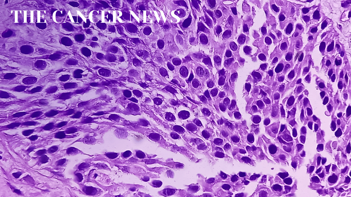 Two Advances Are Reshaping Bladder Cancer Care Before and After Surgery