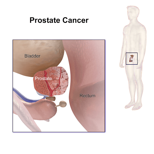 Medical illustration showing prostate cancer location in the male body
