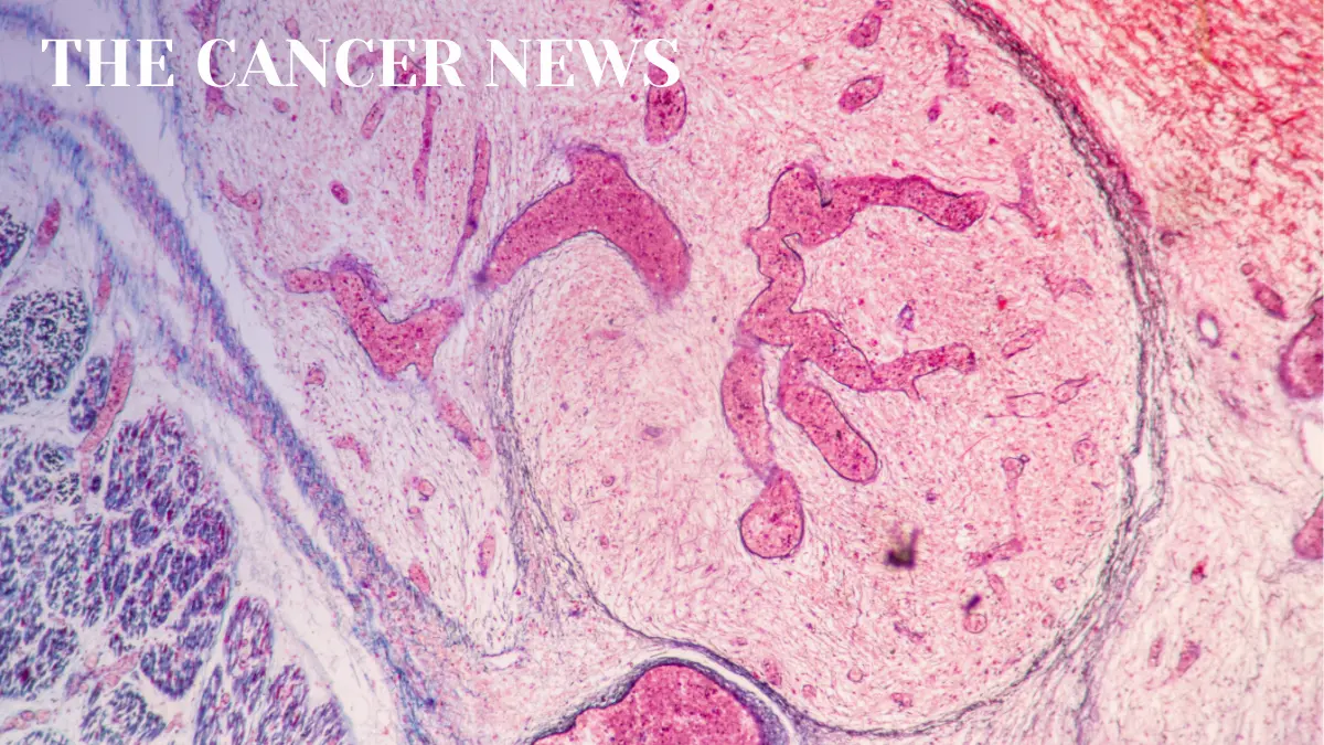The Shifting Playbook for Relapsed Large B-Cell Lymphoma: From Transplant to CAR T and Beyond
