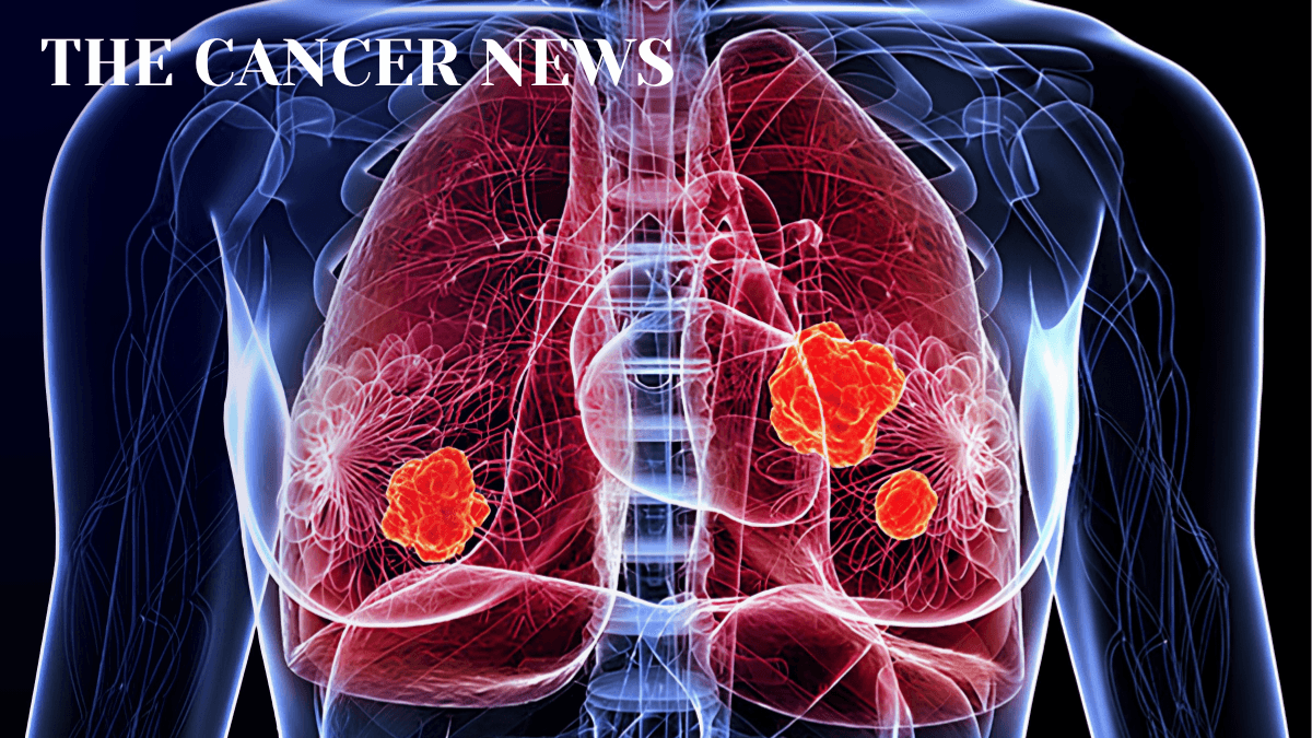 Surgery or Radiation for Stage III Lung Cancer? The Better Question Is Not Which, But When Do We Decide